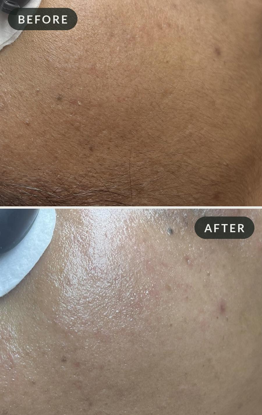 Close-up of a client's cheek before and after a dermaplaning facial at Calming Facials in Issaquah, showing removal of fine facial hair